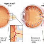 Глаукома – симптомы, причины, виды, лечение и профилактика глаукомы