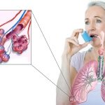 Что нужно знать о астме у взрослых?