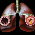 Что нужно знать о внутренней и внешней астме
