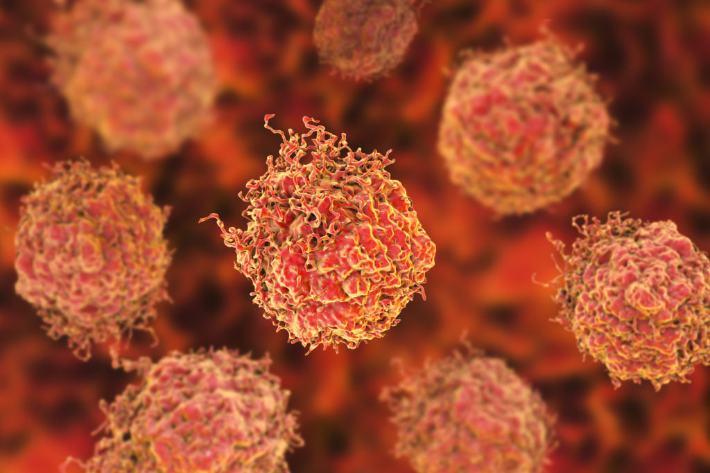 Определен тип опухолевых клеток, который делает рак простаты более агрессивным