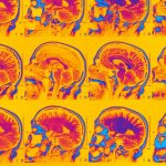 Ориентация на раннее воспаление головного мозга может замедлить болезнь Альцгеймера