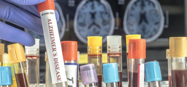 Новый анализ крови показывает большие перспективы в диагностике болезни Альцгеймера