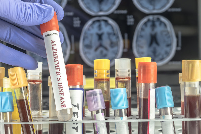 Новый анализ крови показывает большие перспективы в диагностике болезни Альцгеймера
